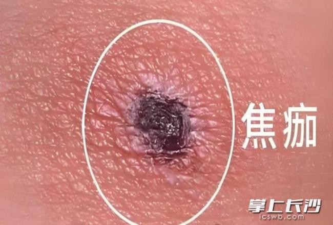 女子高热不退竟是“虫子”作祟 恙虫病需警惕