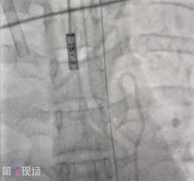 女子漂流呛水后吐血被确诊罕见病 命悬一线终获救