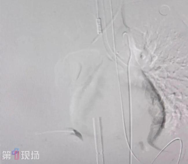 女子漂流呛水后吐200毫升血进ICU 命悬一线获救