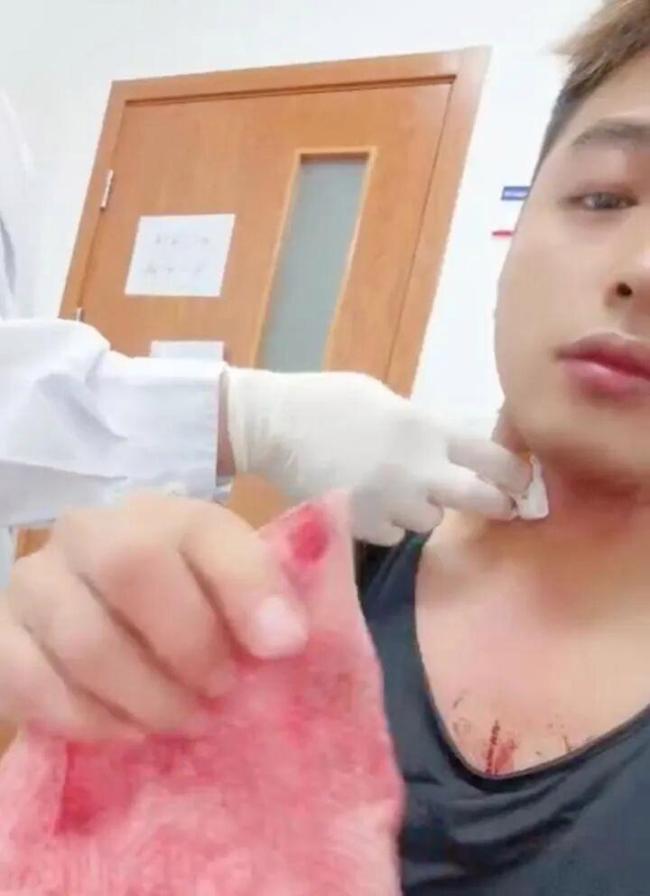 男子被蚊子叮咬脖子,抓挠后血流1小时不止,医生称可能和刚健身完有关 健身后意外引发关注