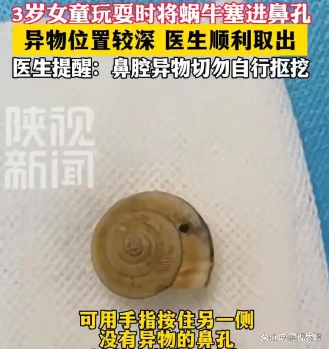 女童好奇塞蜗牛进鼻腔全麻取出 家长冷静判断至关重要