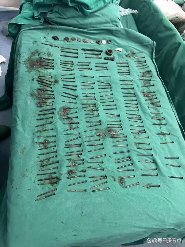 云南一男子胃中取出180颗铁钉