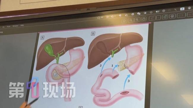 男子手术切除五个器官“保命” 尿液变红揭隐患