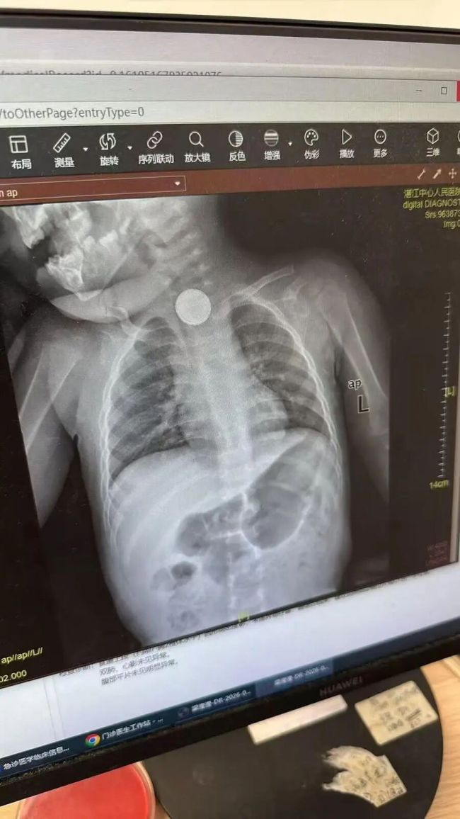 女婴误吞电池26小时食道被腐蚀 警惕早期症状误导