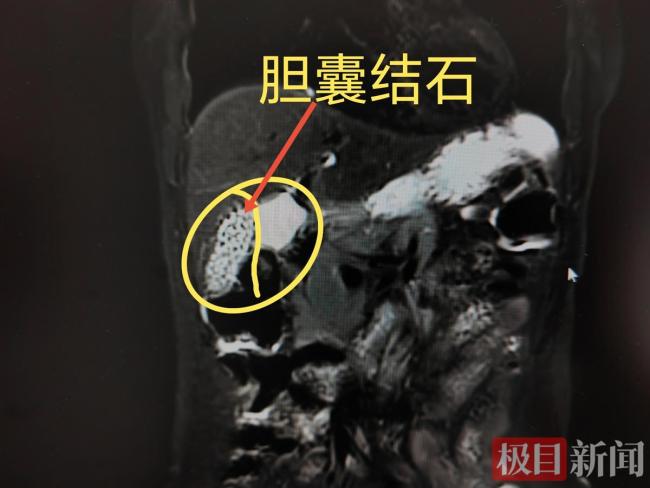 女子查出胆囊结石拖了七年没治