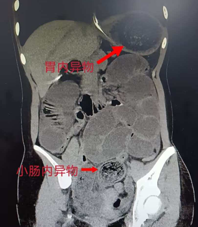 13岁女孩吞食头发致肠梗阻 异食症引发多并发症