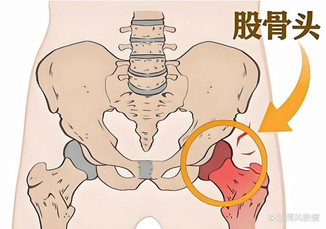 股骨头坏死是什么 被称为“不死癌症”的真相