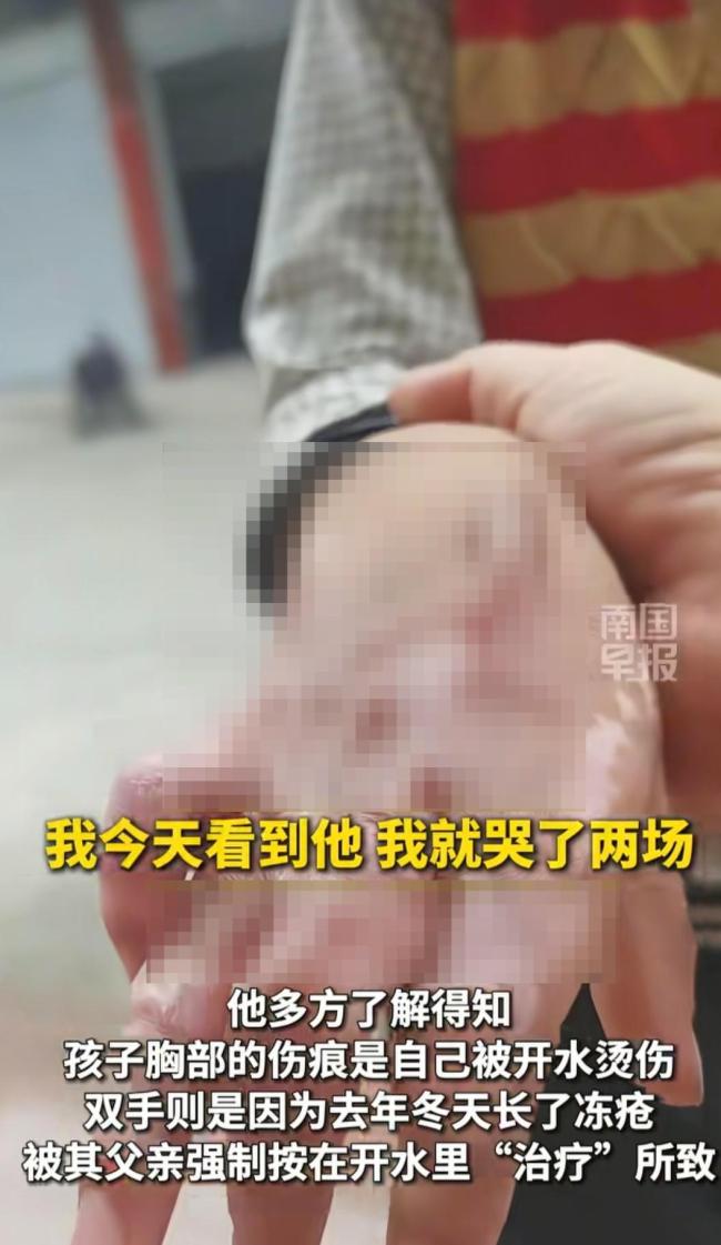 父亲回应9岁男童身上多处伤疤 排除虐待疑虑