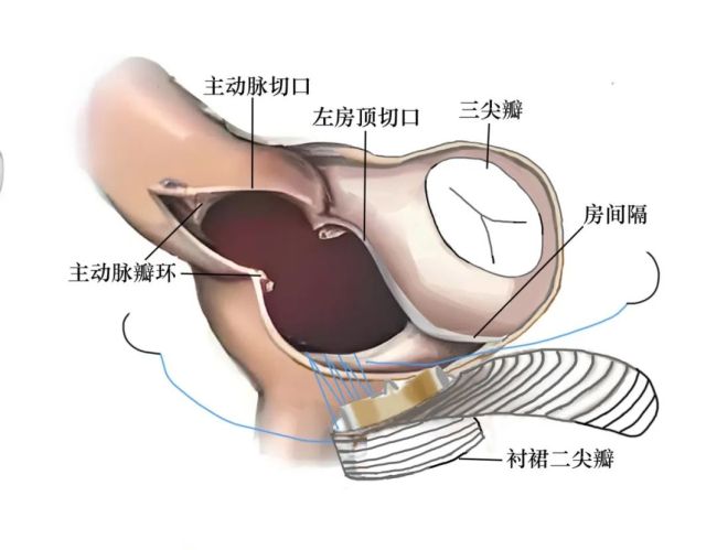 四次心脏手术，两代医生接力，续写生命奇迹——山一大一附院成功开展“衬裙”双瓣膜置换术