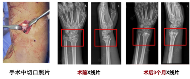 伤筋动骨不再需要一百天恢复啦——浙大邵逸夫医院自研断骨粘合用“骨胶水”，3分钟搞定断骨