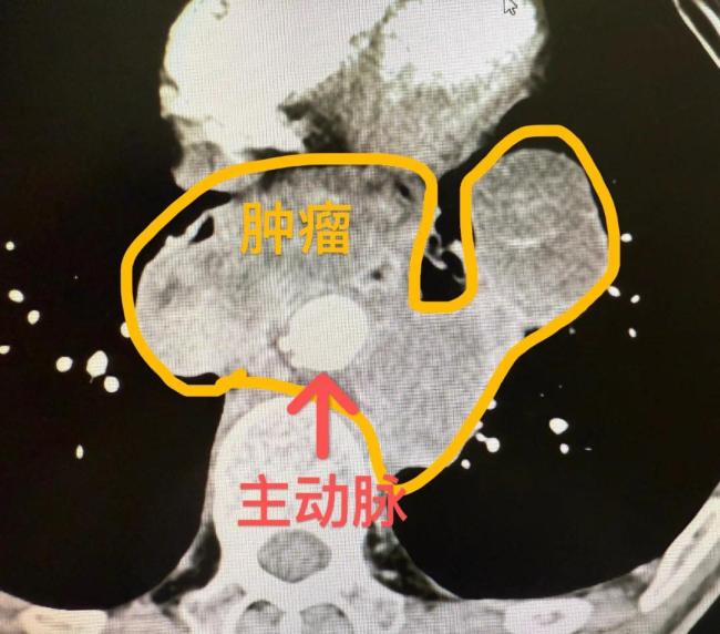 西安国际医学中心医院:无影灯下11小时,为生命打通“生命线”