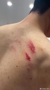 广州队门将背部照片：两道血印，赛中受伤引热议