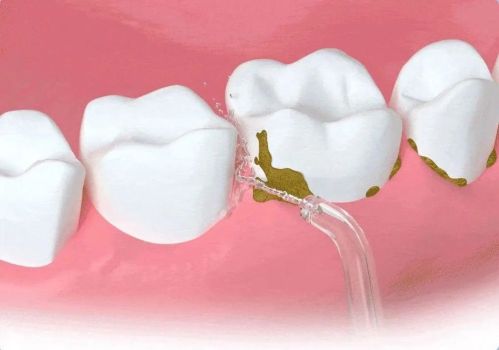 专家称彻底清洁牙齿要靠水流，刷牙时间一般应控制在3分钟左右