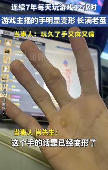 男子做游戏主播7年如今手指严重变形 长期劳累致手部损伤