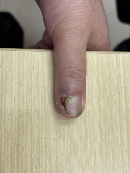 男子指甲旁长肿物确诊恶性黑色素瘤 小毛病大隐患