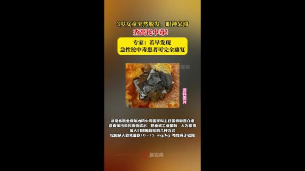 3歲女童突然脫發(fā)查出鉈中毒 鉈中毒癥狀及治療解析