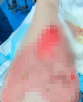 女子乘飛機被熱茶燙傷 航空公司回應(yīng)爭議