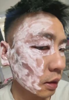 男子用餐廳毒紙巾擦臉皮膚嚴(yán)重過(guò)敏 劣質(zhì)紙巾隱患大