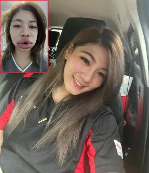 泰女子注射玻尿酸唇腫如香腸 嚴(yán)重過敏引關(guān)注