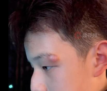 演员关凌提醒网友脸上长东西别手挤 血泪教训警示