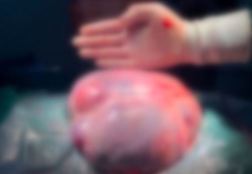 12岁女孩肚子疼竟是长4公斤肿瘤