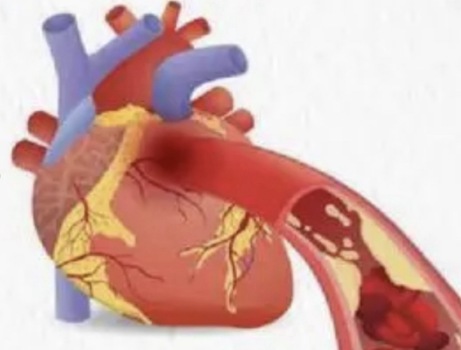 “坏胆固醇”克星催生百亿美元市场 新型口服药显著降脂