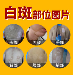 郑州西京白癜风医院治疗女性白斑怎么样