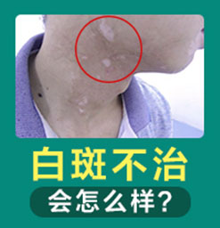 郑州西京白癜风医院如何治疗白斑