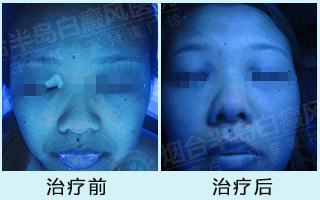 烟台白癜风治疗一般需要多久 想*好该怎么做