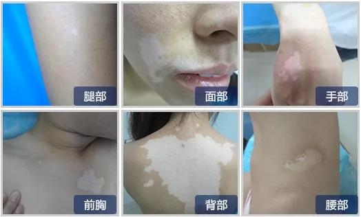 烟台哪家白癜风医院排名靠前 烟台半岛白斑*怎样