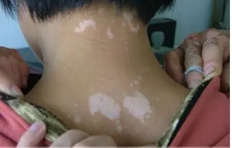 早期白斑去威海专科医院治*果如何