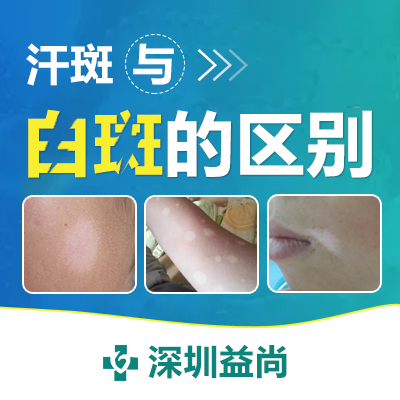 手部白癜风扩散要如何治疗?问深圳益尚白斑专科*