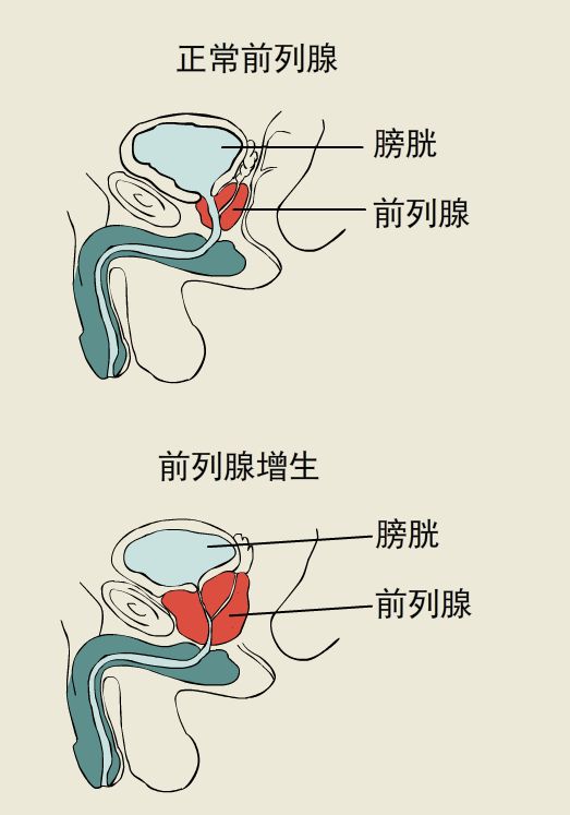 长春男科医院讲讲前列腺增生的那些事