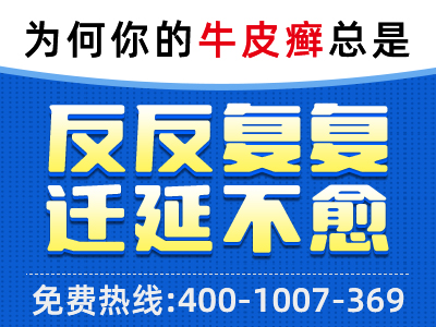 关节型银屑病表现_关节型银屑病原因