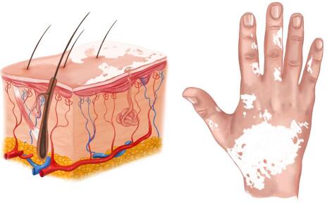 阜阳白癜风专科医院-身上的白斑为什么会变多了?