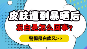 昆明治疗白癜风医院 308准分子激光治疗白斑效果