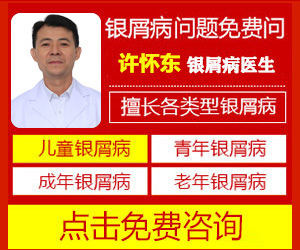 点滴状银屑病初期有哪些特点_点滴型银屑病初期多长时间治 愈