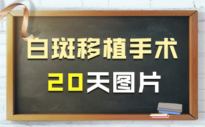 郑州白癜风医院在哪里啊?小面积如何护理自己的白癜风呢