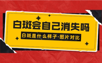 郑州西京白斑医院怎么样?夏季哪些原因会引发白癜风?