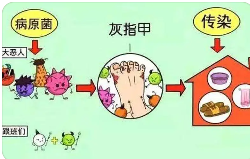 上海灰指甲哪个医院治得好-为什么我们会得灰指甲