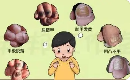 上海治灰指甲医院排行-上海正规医院治疗灰指甲要多少钱