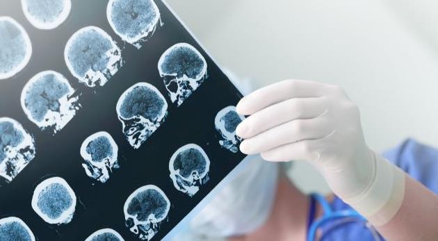 武汉专业治癫痫医院医生在线问诊—了解癫痫与大脑健康的关系
