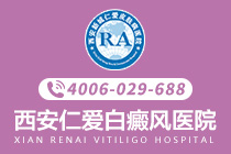 排名揭晓：西安专业白癜风医院排行榜-局限型白癜风症状的表现